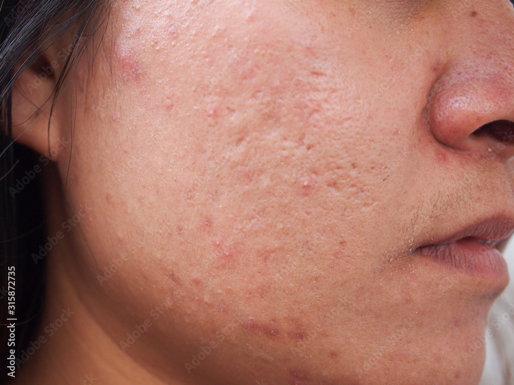 Acne pimple on face of Asian woman.Face skin Problem concept.