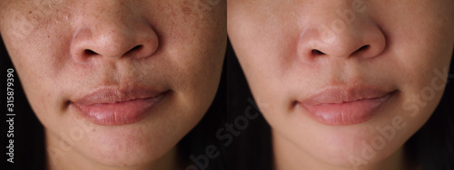 Image before and after spot melasma pigmentation facial treatment on face asian woman.Problem skincare and health concept.