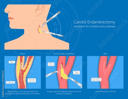Carotid duplex doppler artery ultrasound disease diagnosis treatment photo
