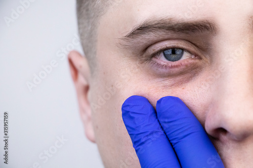 Bags under the eyes, hernias on the face of a man. Plastic surgeon examines a patient before blepharoplasty photo