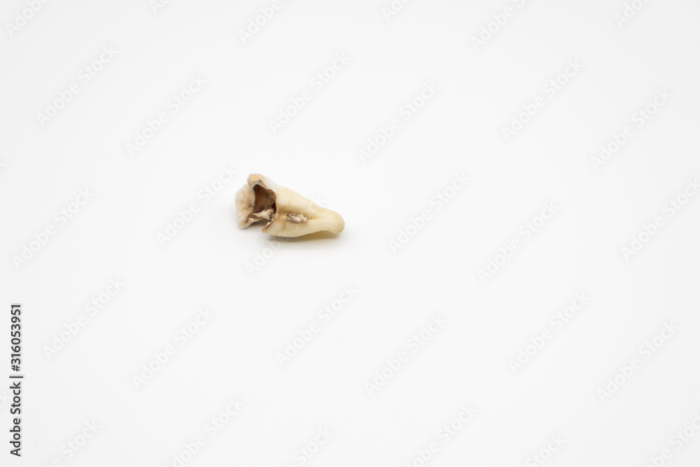 Wisdom tooth with serious decay Wisdom tooth with serious decay
