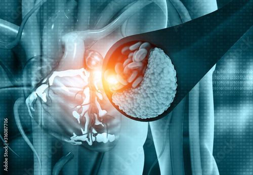 Coronary artery disease. Heart with blocked arteries. 3d illustration photo