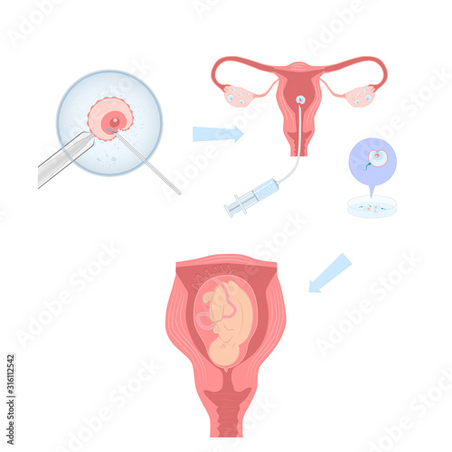Artificial insemination illustration, process infographics. Vector illustration