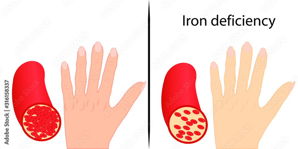 Iron deficiency: Some serious signs may appear on skin, nails and taste |  Health Tips and News