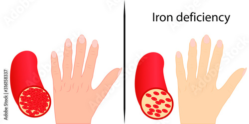 Sign of chronic iron deficiency yellow skin vector illustration