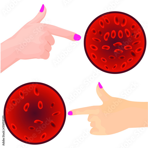 Sign of chronic iron deficiency yellow skin vector illustration