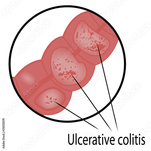 Ulcerative colitis intestine disease vector graphic illustration for medical use