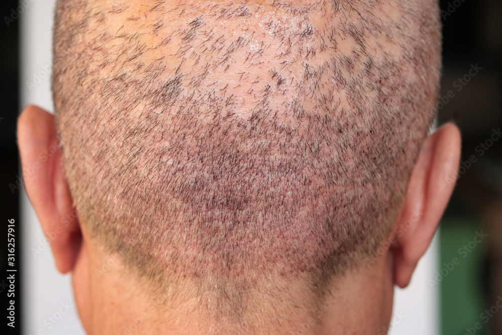 back view of a man's head with hair transplant surgery area Stock Photo |  Adobe Stock
