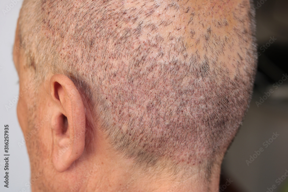 Fototapeta premium view of a man's head with hair transplant surgery area