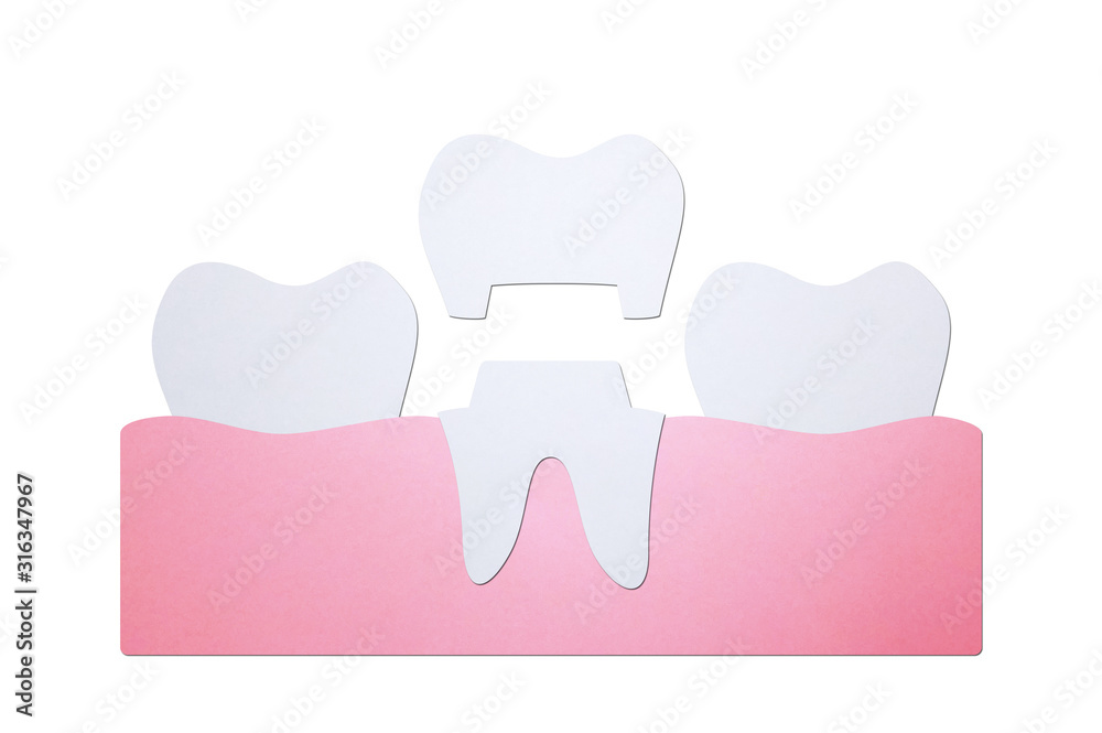 dental crown, installation process and change of teeth - tooth cartoon paper cut style