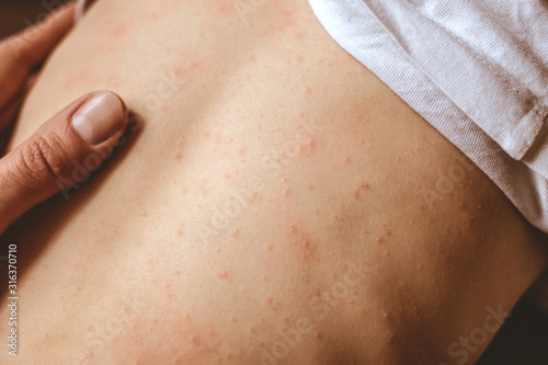 rash on the child's back. red rash in children of preschool age. rubella and chickenpox