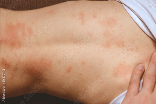 rash on the child's back. red rash in children of preschool age. rubella and chickenpox photo