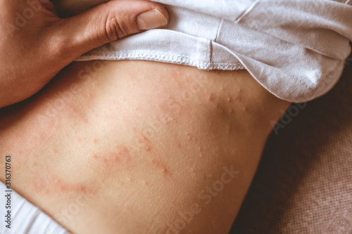 rash on the child's back. red rash in children of preschool age. rubella and chickenpox photo