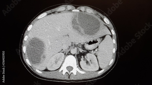 Amoebic abscesses of the liver on CT of abdomen photo