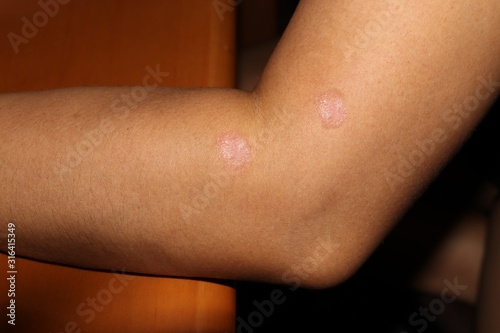 Psoriasis on side of female elbow