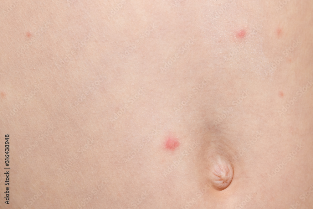 Varicella virus or Chickenpox bubble rash on boy Varicella virus or Chickenpox bubble rash on boy