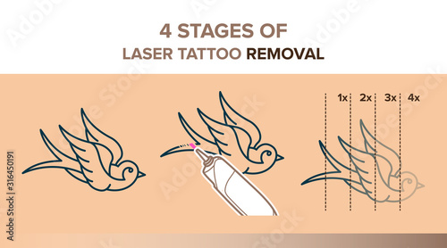 4 Stages of laser tattoo removal illustration. Vector icons