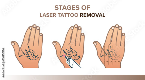 Stages of laser tattoo removal illustration