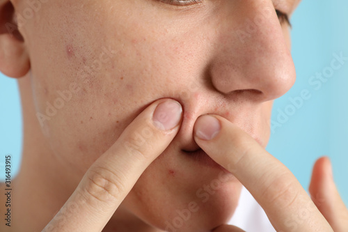 Teen guy with acne problem squeezing pimple on light blue background, closeup