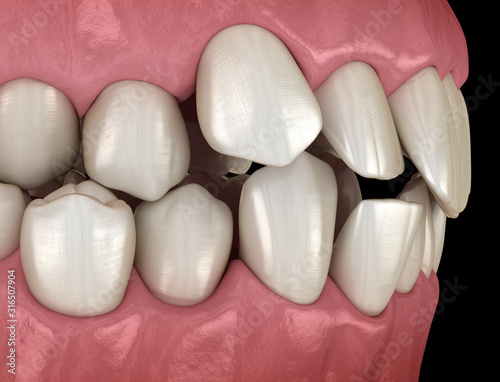 Canvas Print Abnormal teeth position, orthodontic concept