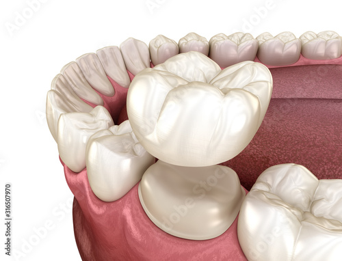 Preparated molar tooth for dental crown placement. Medically accurate 3D illustration