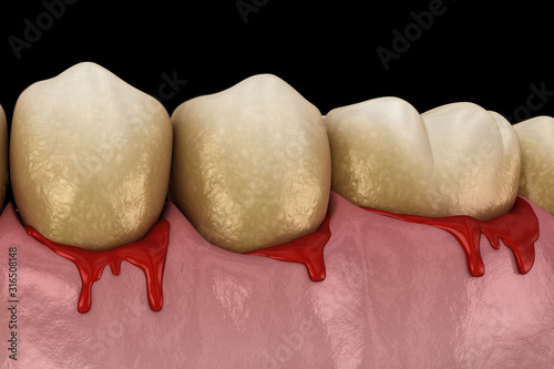 Bleeding gums or Periodontal - pathological inflammatory condition of the gum and bone support. Dental 3D illustration photo