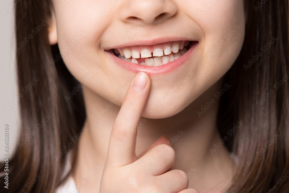Close up little preschool girl showing growing first permanent molar. Close up little preschool girl showing growing first permanent molar.