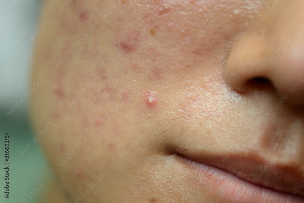 Young Asian woman showing her face with acne and moles Young Asian woman showing her face with acne and moles