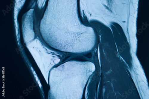 Canvas Print Knee injury mri mcl tear