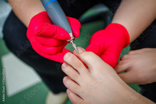 Podiatrist treating toenail fungus. Podology treatment. Close-up. photo