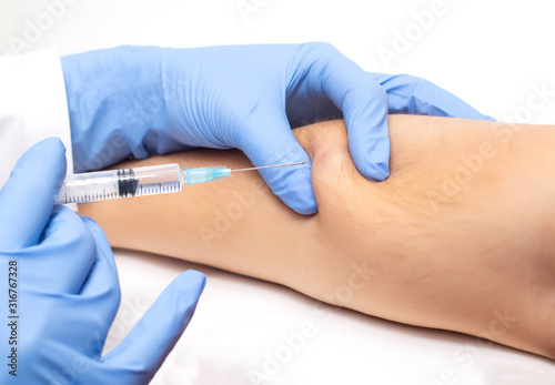 The doctor uses a syringe to take a skin biopsy from the patient. The concept of malignant subcutaneous lesions, close-up photo
