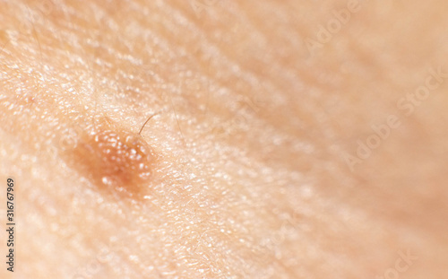Mole mole on the skin of a person, dermatology, background, copy space. Macro
