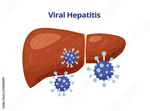 Viral hepatitis, damages liver and viruses vector flat illustration isolated on white background.