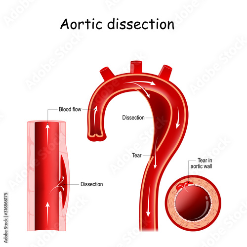 Aortic dissection photo
