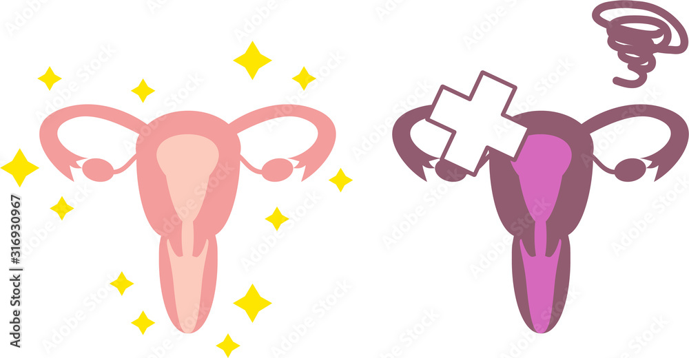 シンプルな健康・不健康な子宮のイラスト　内臓　/ 生殖器