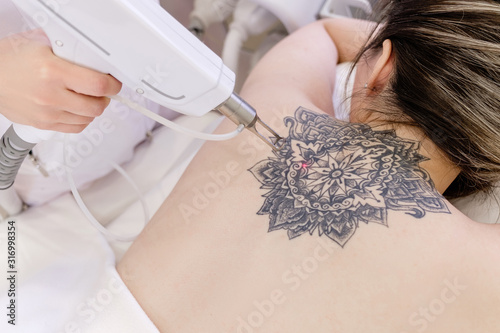 Obraz na plátně Top view hand of a beautician holds a laser device over a tattooed back of a girl to remove an unwanted tattoo