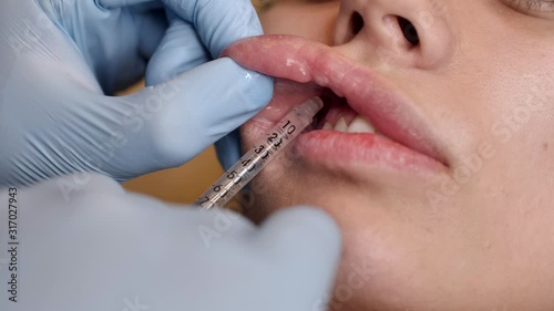 Close-up of a dentists hands in a blue gloves holding syringe and giving dental anesthesia to female patient. photo