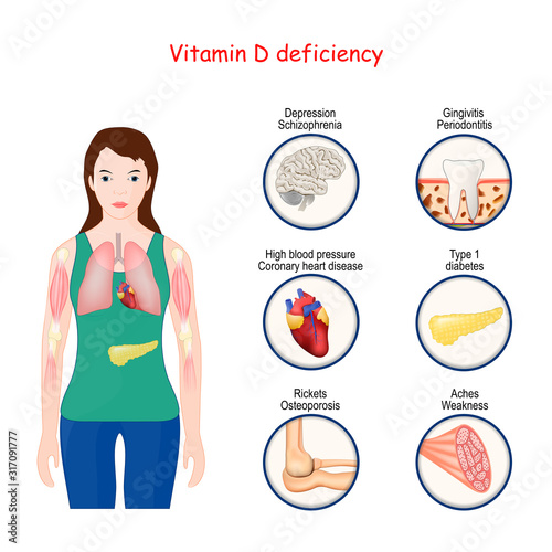 Vitamin D deficiency. Human body, and close-up of organs with effects of deficiency.