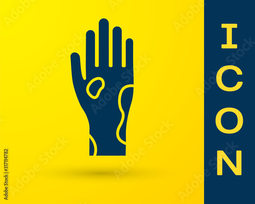 Blue Hand with psoriasis or eczema icon isolated on yellow background. Concept of human skin response to allergen or chronic body problem. Vector Illustration
