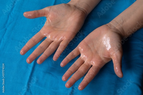 Tableau sur toile Close up of wet palms on light blue towel showing palmar hyperhidrosis, excessiv