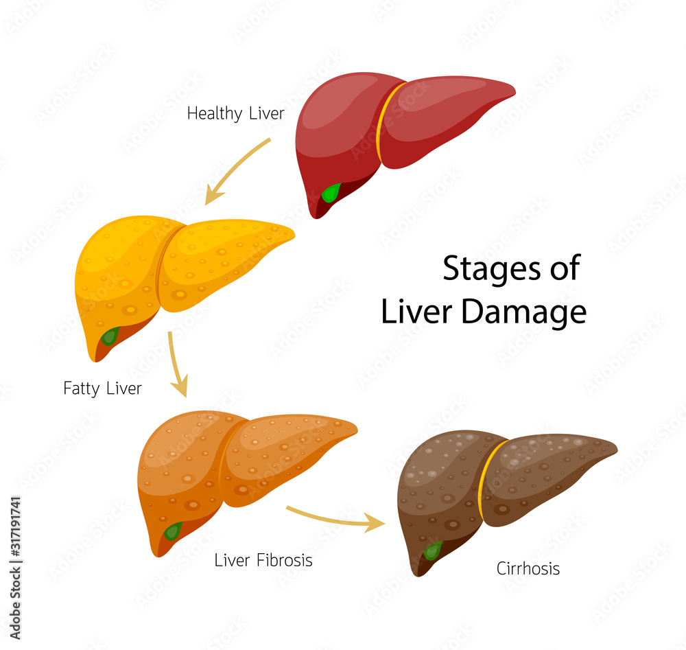 Stages of liver damage. Liver Disease. Healthy, fatty, fibrosis and ...