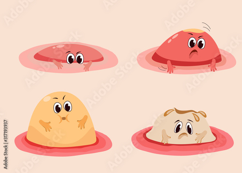 Different stages of acne.