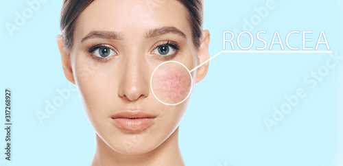 Woman with couperose on face skin. showing skin problems couperose-prone sensitive skin photo