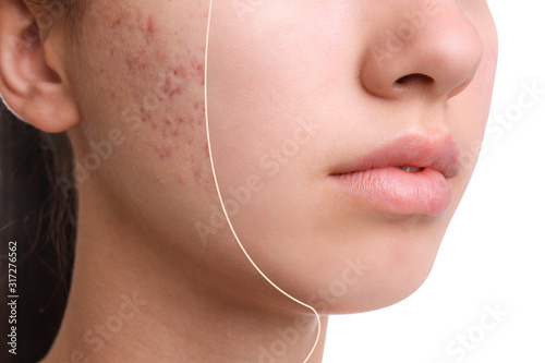 Teenage girl before and after acne treatment on white background, closeup photo