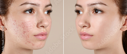 Teenage girl before and after acne treatment on beige background photo