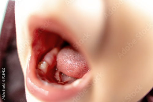 фотографія Close up of baby new tooth. Teething, ache and pain