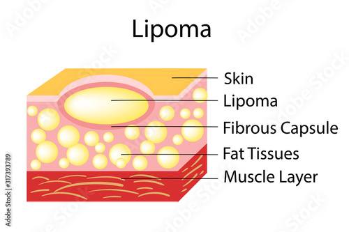 Lipoma are adipose tumors located in the subcutaneous tissues.