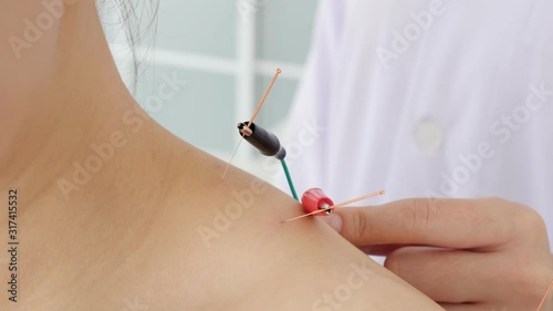 Asian woman receiving acupuncture with electric stimulation at shoulder in a hospital,Chinese alternative medicine concept.