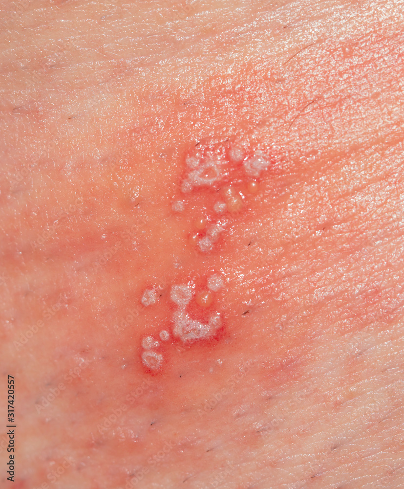 Fototapeta premium skin irritation in the form of blisters and inflammation