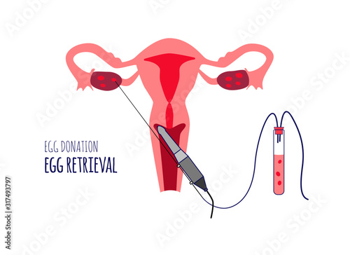 Egg retrieval. Egg donation. Donor. In vitro fertilization. Vector illustration.